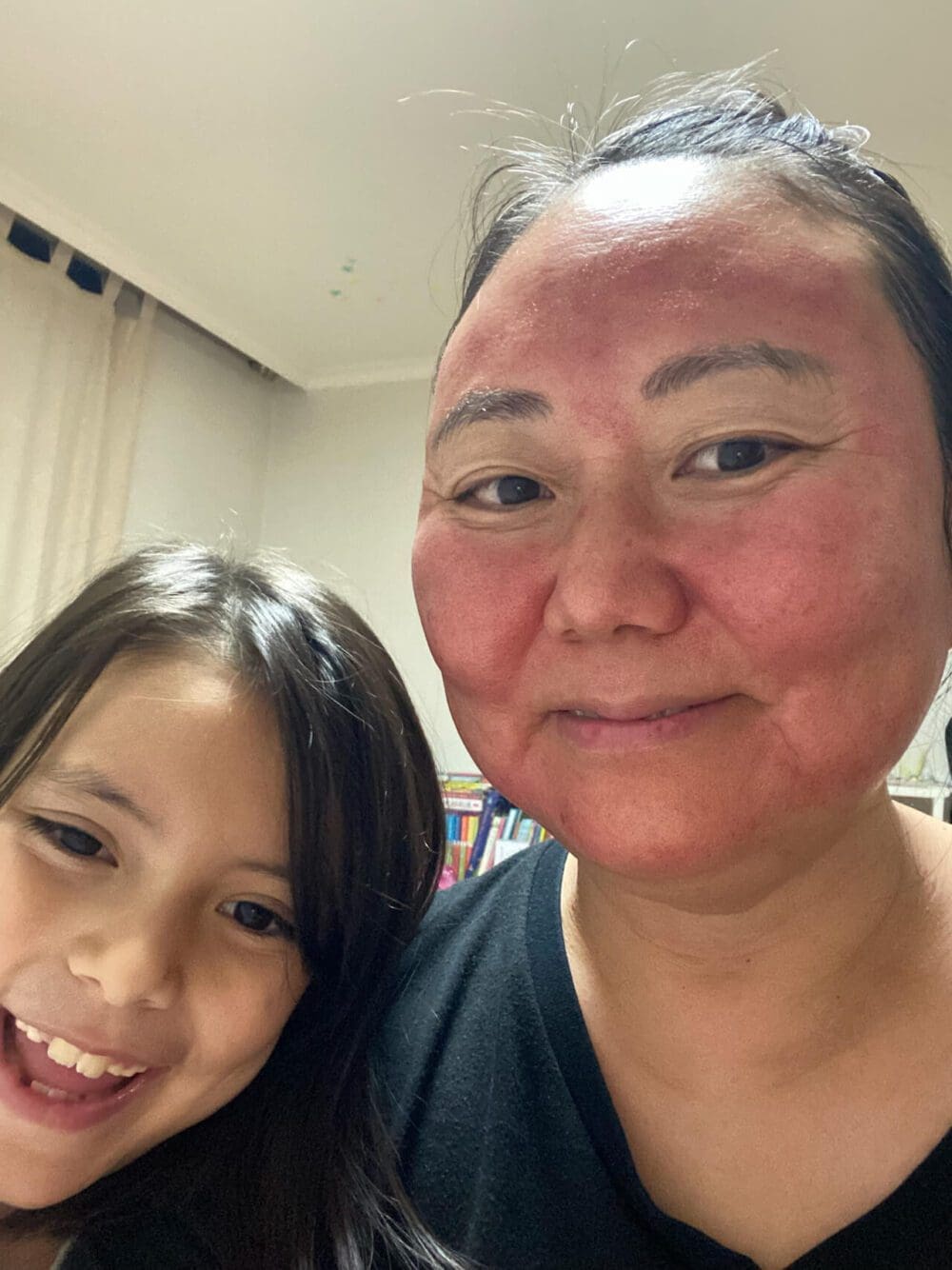 skin treatments in seoul | after microneedling