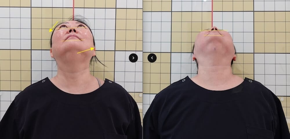 I Had 7 Korean Medicine Treatments for Buffalo Hump & Facial Asymmetry at Duna Clinic in Seoul — The Results Surprised Me 28 before and after images from facial asymmetry treatment at duna clinic in seoul