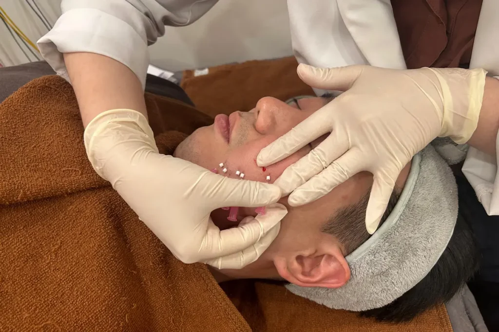 A close-up view of a practitioner in medical gloves performing a korean traditional dermatology
