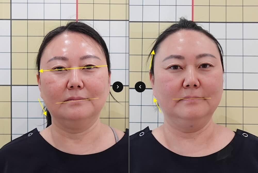 I Had 7 Korean Medicine Treatments for Buffalo Hump & Facial Asymmetry at Duna Clinic in Seoul — The Results Surprised Me 24 Before and after facial asymmetry treatments at Duna Clinic in Seoul.