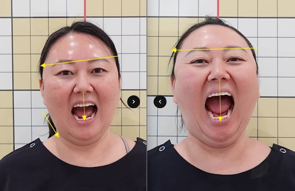 I Had 7 Korean Medicine Treatments for Buffalo Hump & Facial Asymmetry at Duna Clinic in Seoul — The Results Surprised Me 26 before and after results from facial asymmetry treatments at duna clinic in seoul