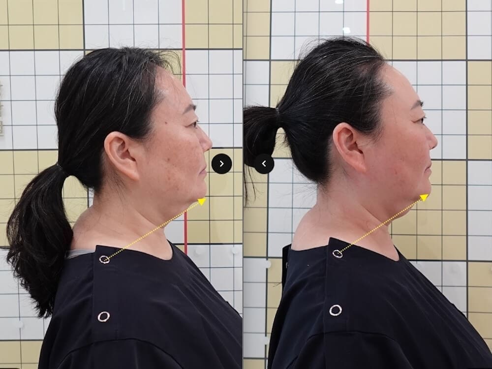 I Had 7 Korean Medicine Treatments for Buffalo Hump & Facial Asymmetry at Duna Clinic in Seoul — The Results Surprised Me 27 results of buffalo hump treatment at duna clinic in seoul korea