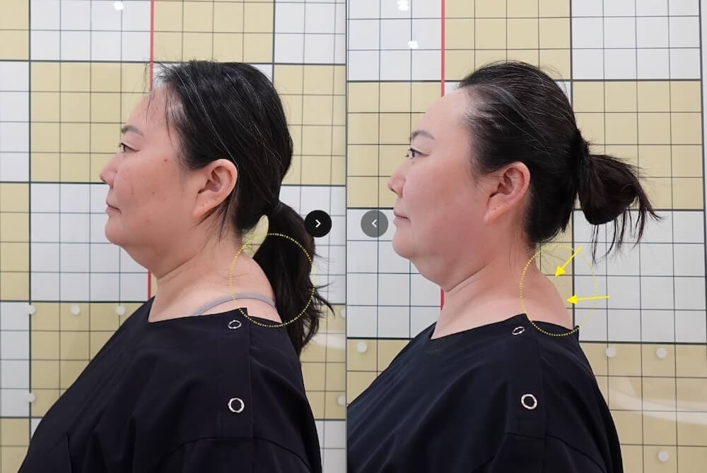 I Had 7 Korean Medicine Treatments for Buffalo Hump & Facial Asymmetry at Duna Clinic in Seoul — The Results Surprised Me 25 before and after images from buffalo hump treatment at duna clinic in seoul korea